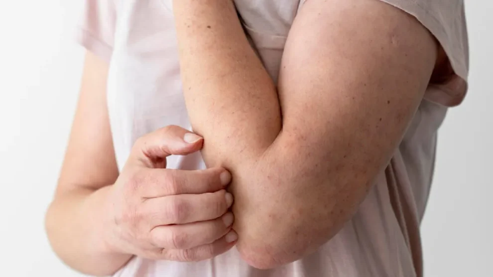 Jundiaí amplia diagnóstico de hanseníase com questionário online no Janeiro Roxo